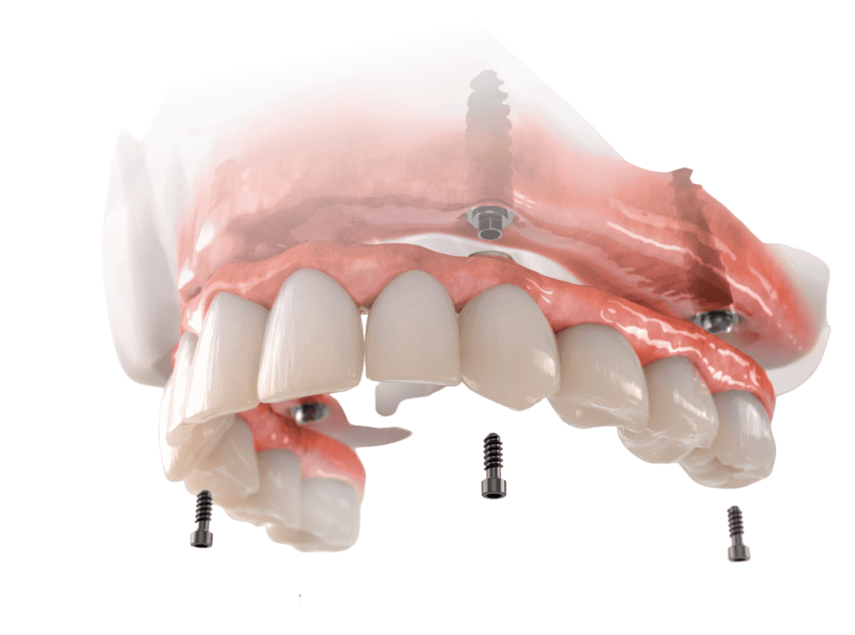 Implantes dentários